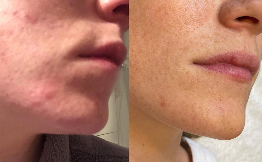 georgia before after dermapen skin texture web